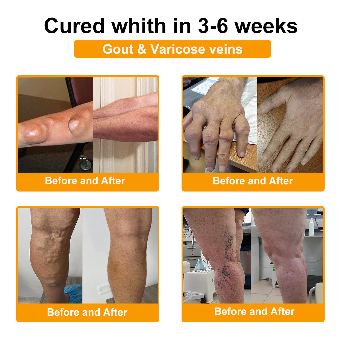 🎁Flash Sale - SEAGRIL™ Botulinum Toxin & Bee Venom Pain-Relief Bone Healing Cream🐝💎