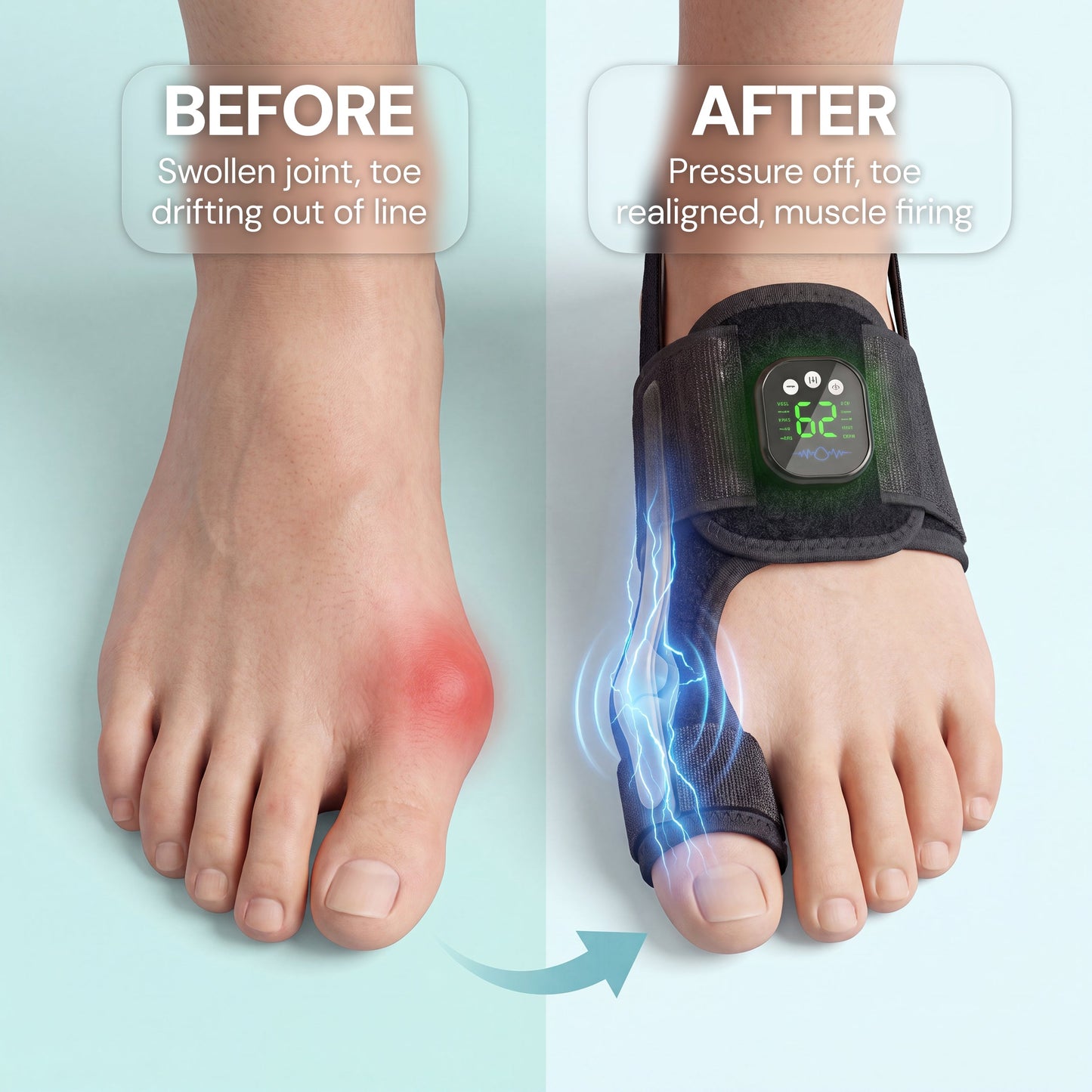 Kadvio's EMS Bunion Corrector